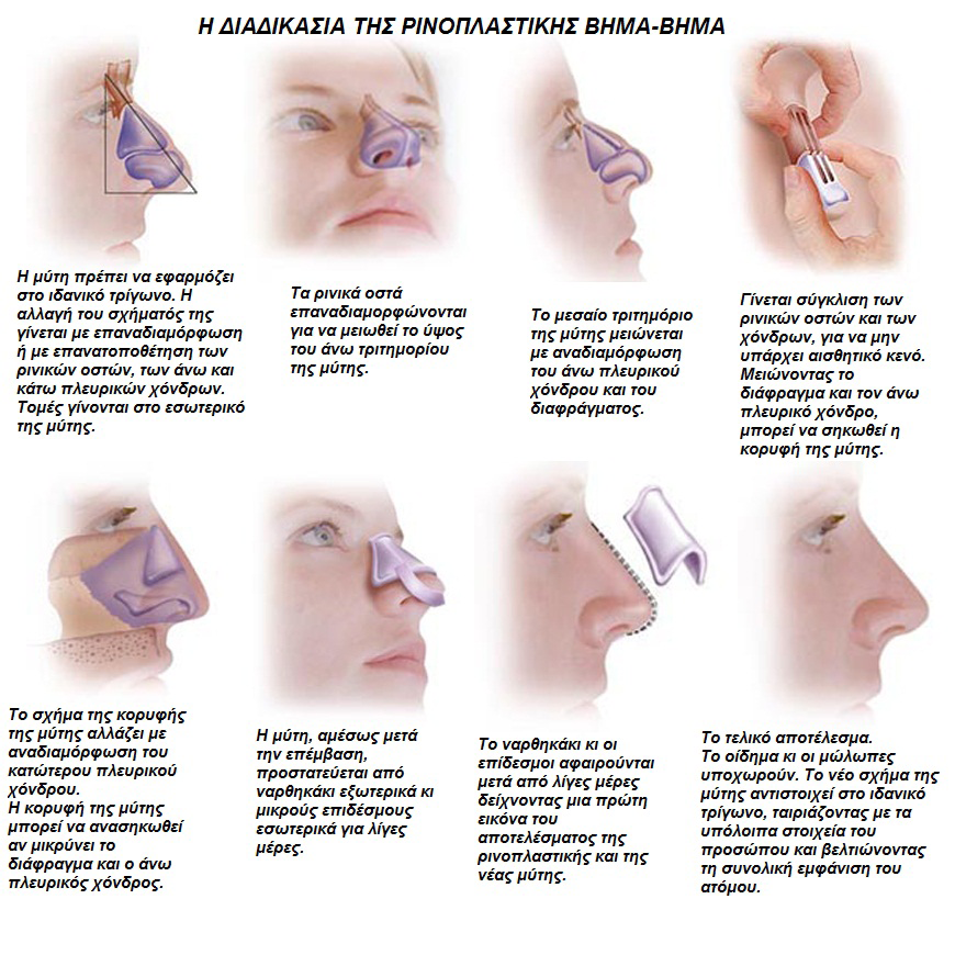 διαδικασια της ρινοπλαστικης βημα βημα