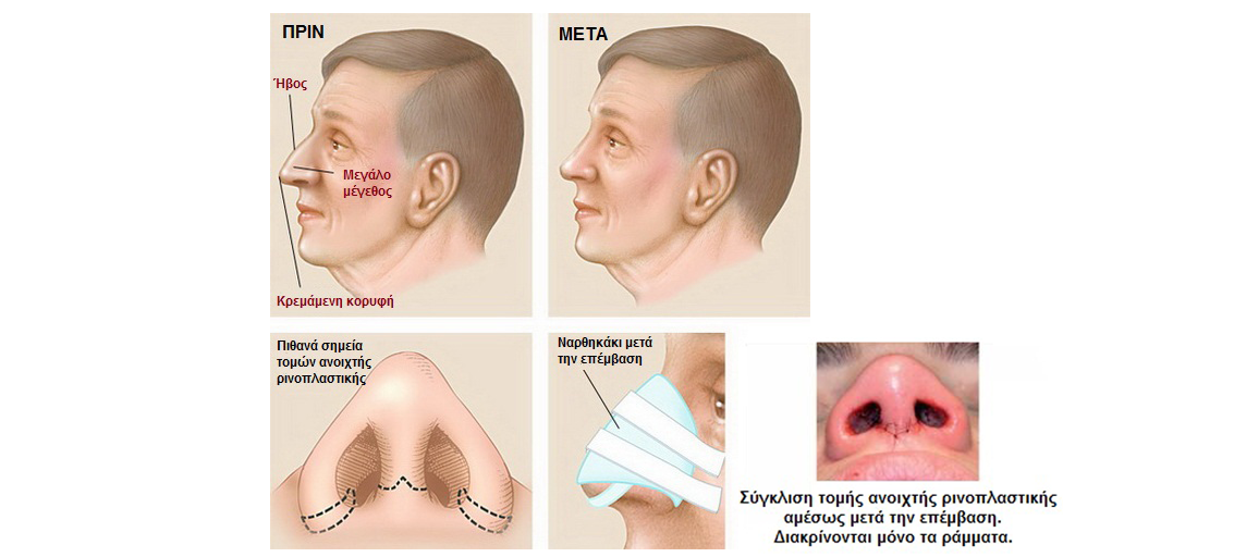 τομες μετα τη ρινοπλαστικη