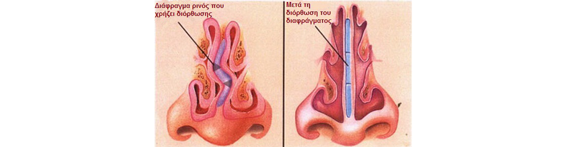 septoplasty